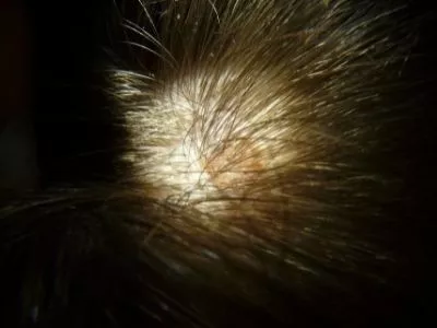 redness on the scalp duw to bed bugs bite