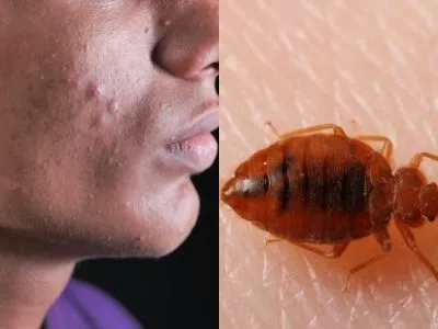 Chickenpox vs Bed Bugs Bites
